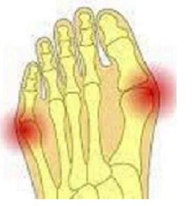 Schneiderballen, Kleinzehenballen, Halluc valgus. Medical Herb Lab